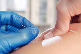 Dry Needling